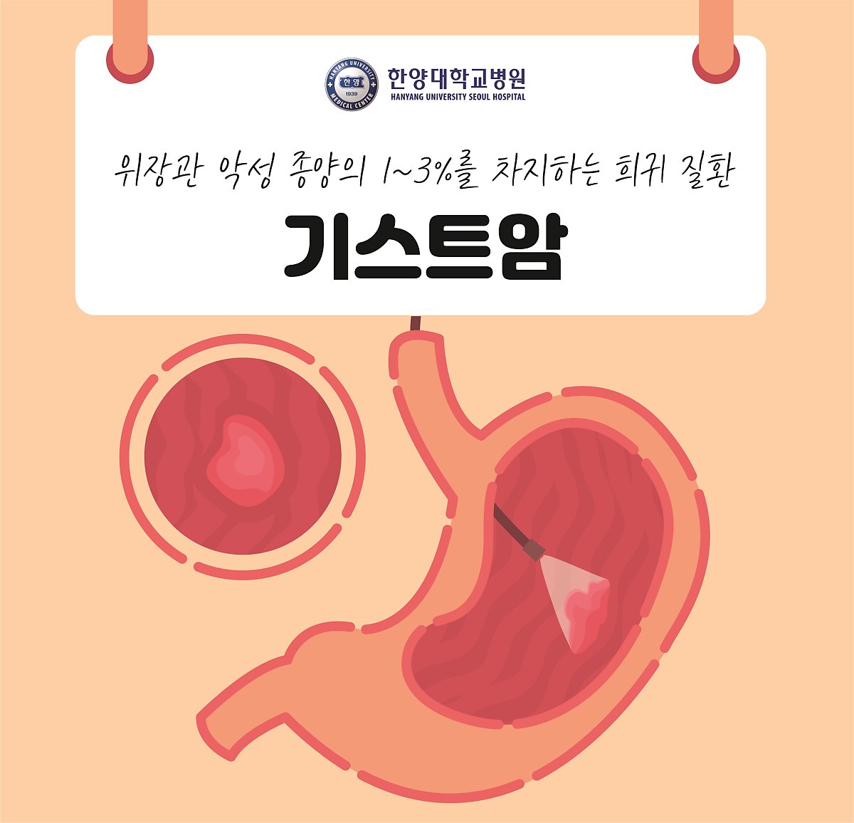 위장관 종양 중 1~3% 희귀 질환, 기스트암
